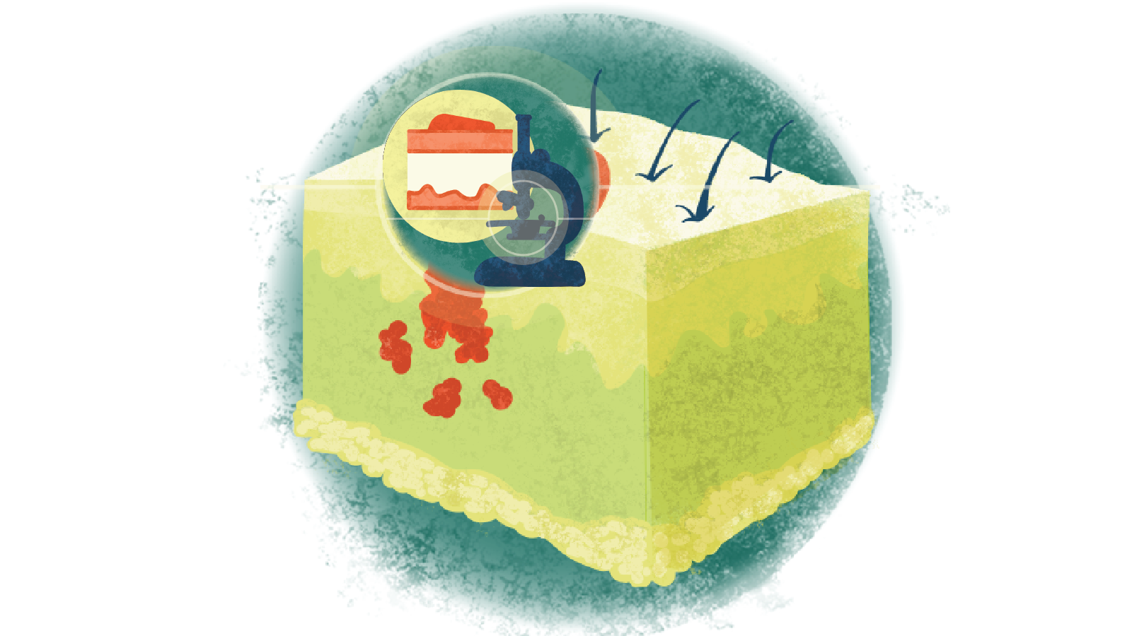 Illustration of a layer of epidermis in a circle and a microscope over melanoma of the skin