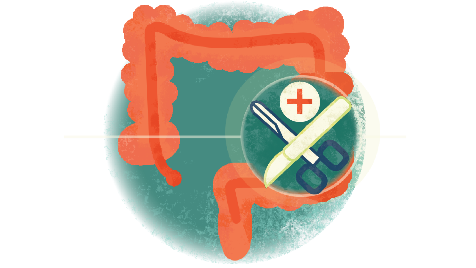 Illustration of a scalpel, scissors and medical red cross in a circle over a colon with ulcerative colitis