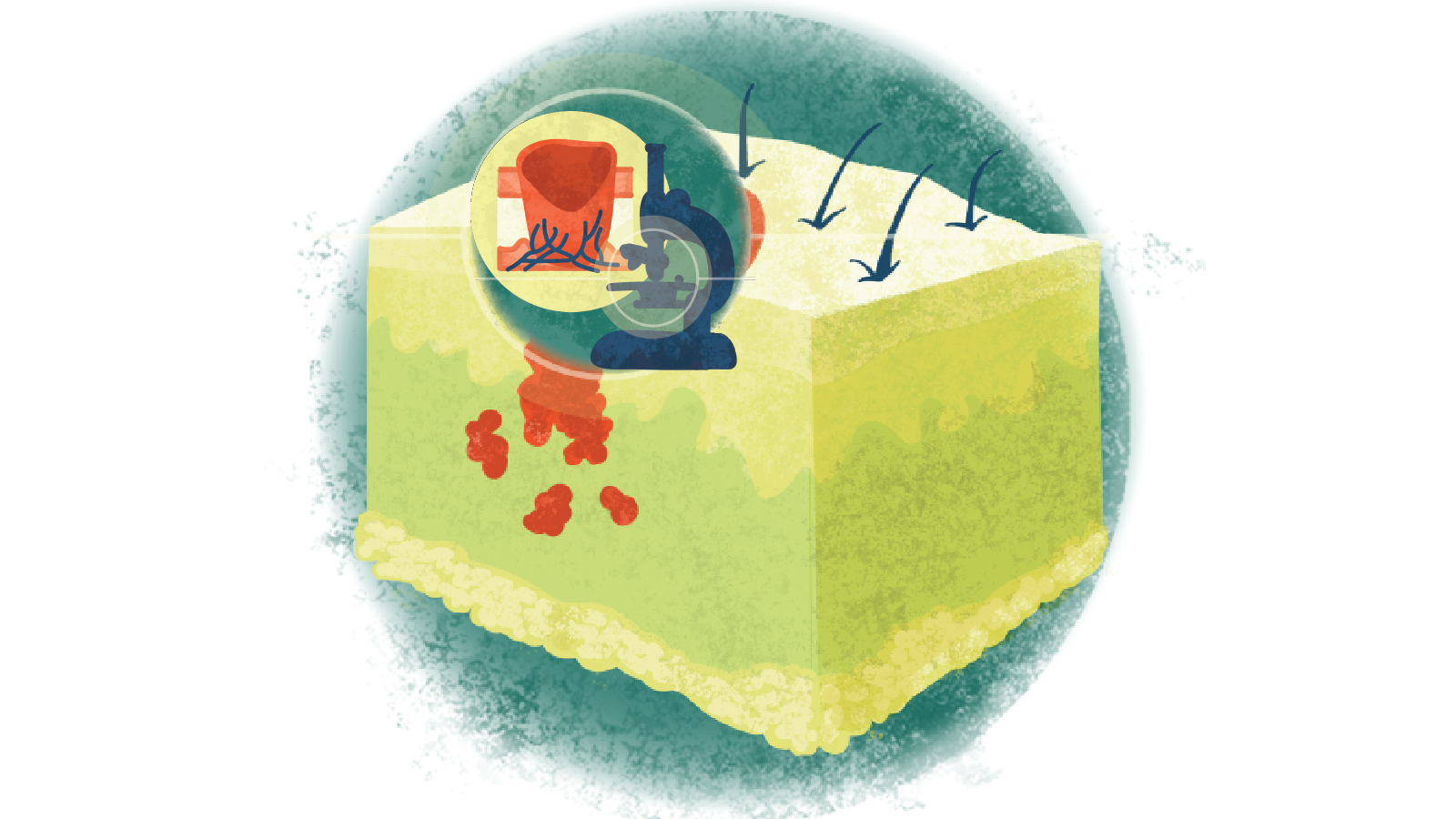 Illustration of a close-up of metastatic melanoma and a microscope over melanoma of the skin