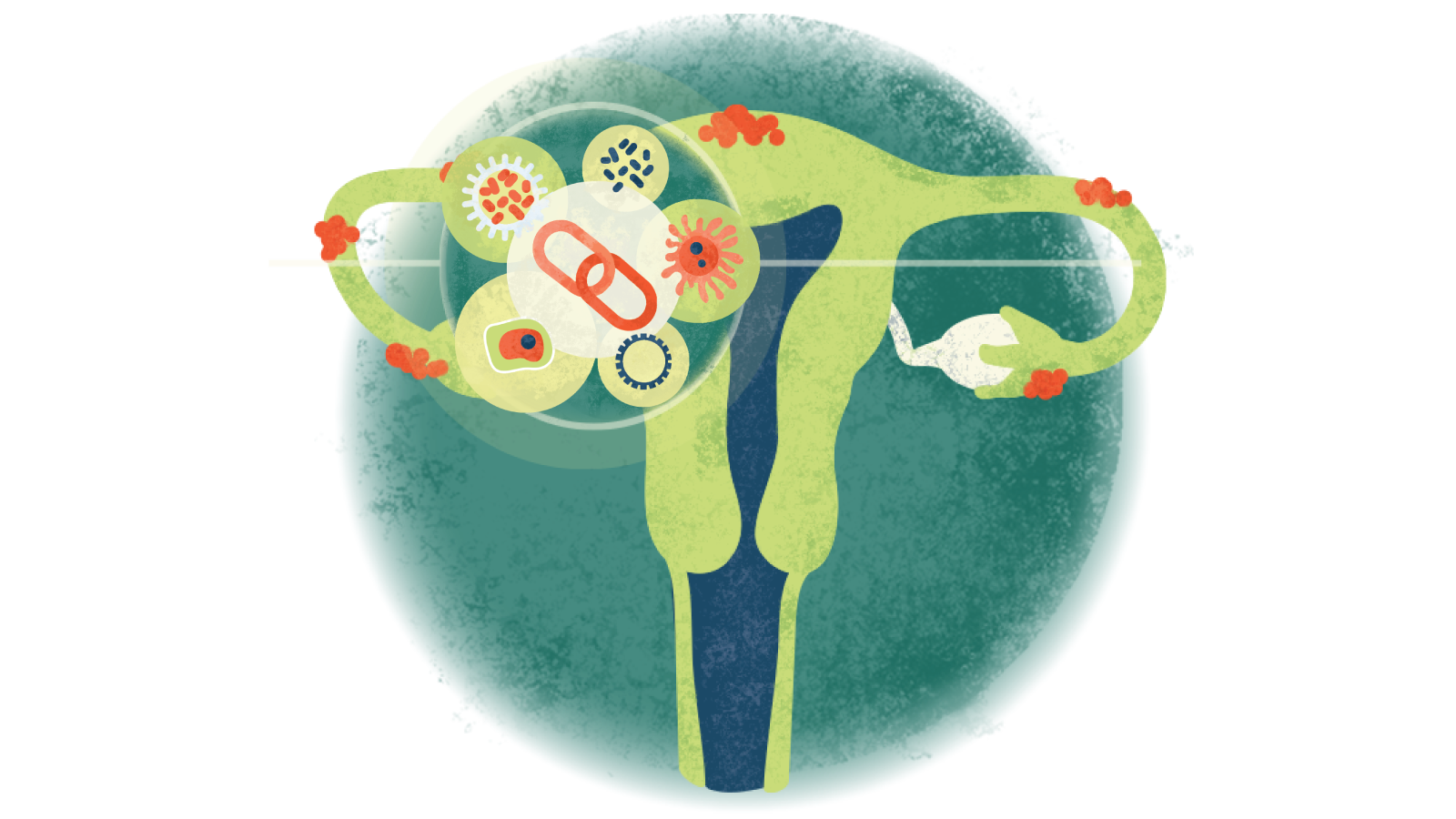 Illustration of a chain link surrounded by diseases in a circle over a uterus with endometriosis