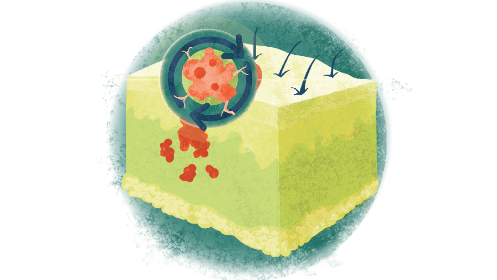 Illustration of a close-up of metastatic melanoma with arrows going around over melanoma of the skin