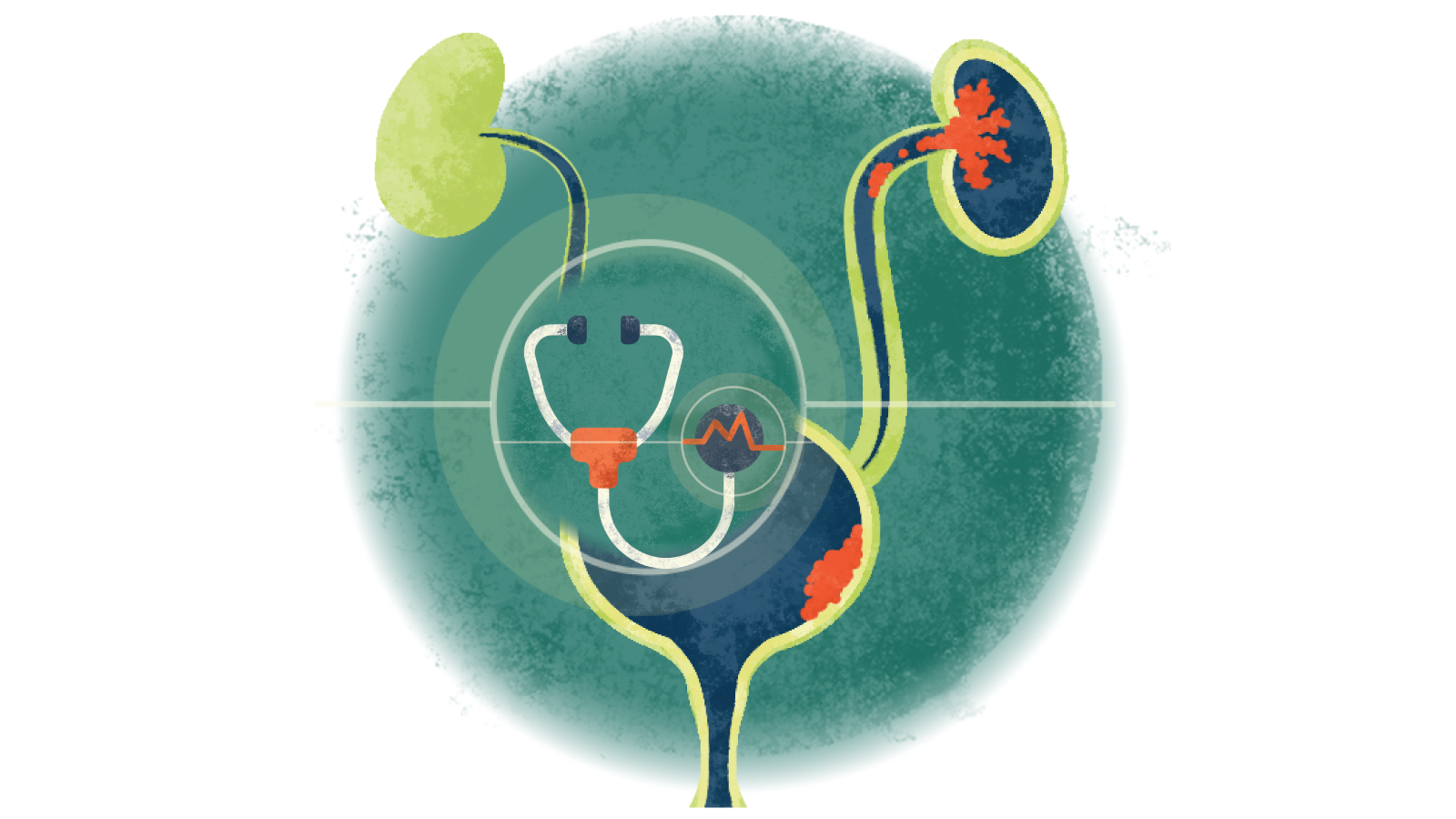 Illustration of a stethoscope with an electrocardiogram in a circle over a bladder with Urothelial Cancer