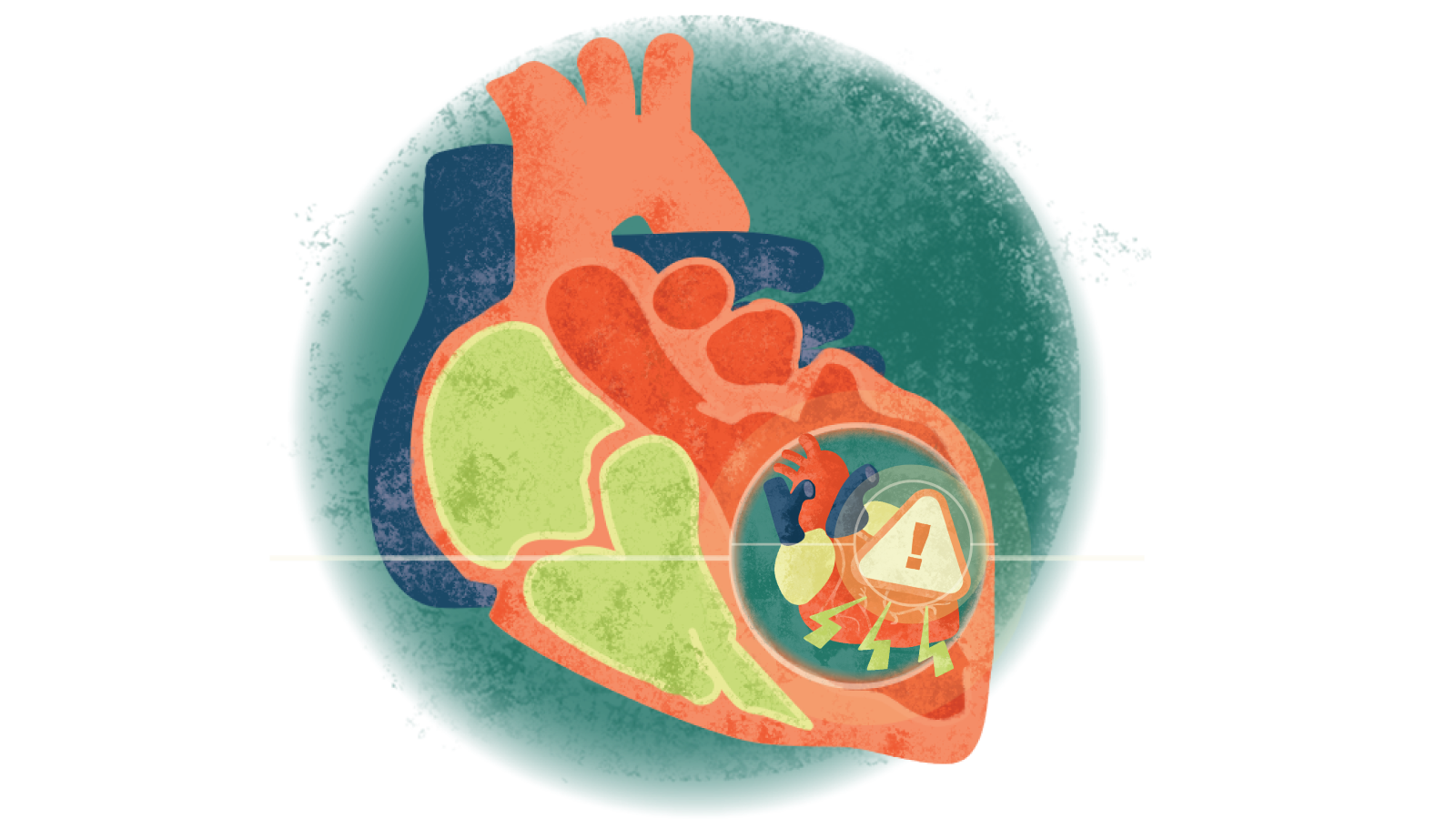Illustration of electrical jolts and an exclamation point in a triangle in a circle over a heart with cardiomyopathy