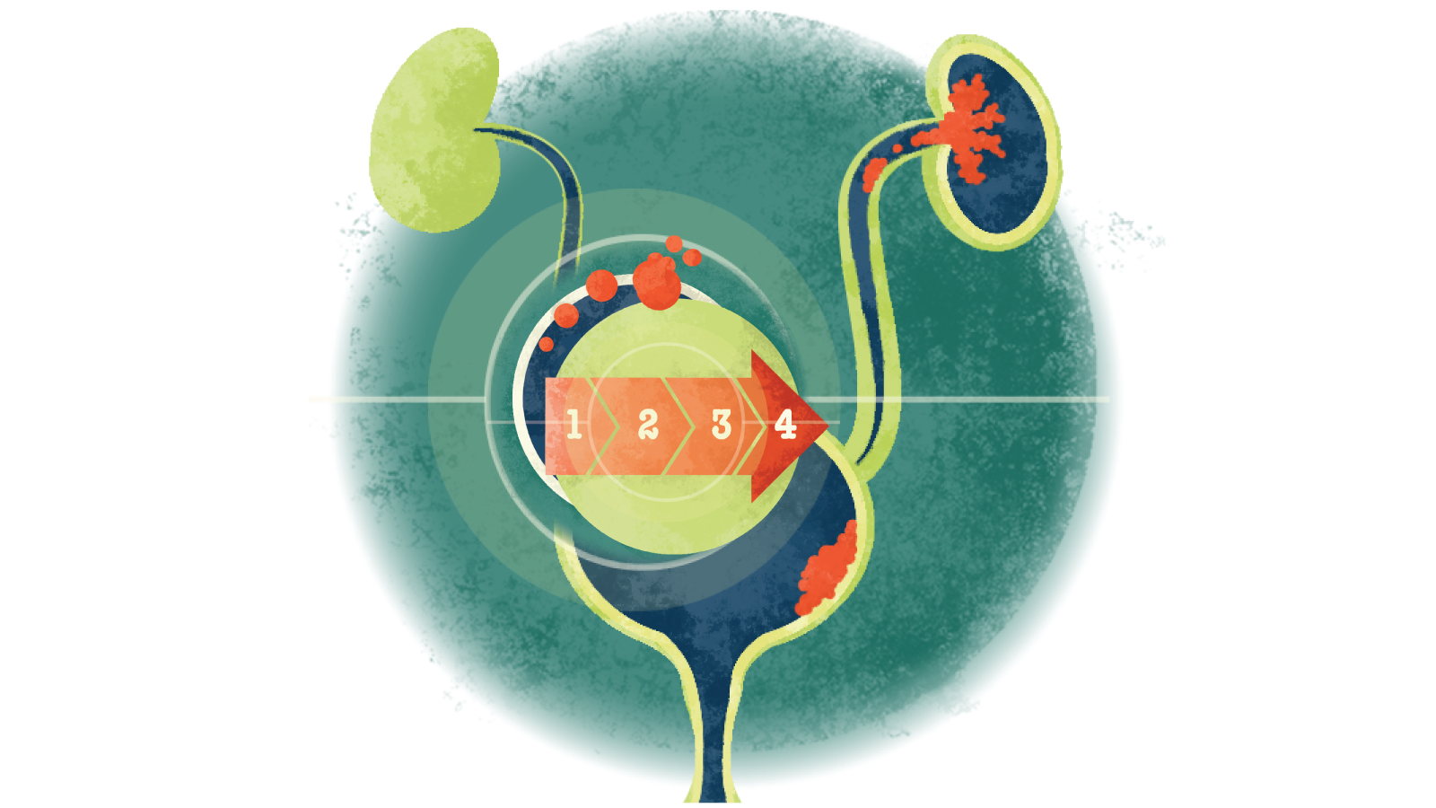 Illustration of a red arrow with the numbers 1-4 over two circles over a bladder with urothelial cancer