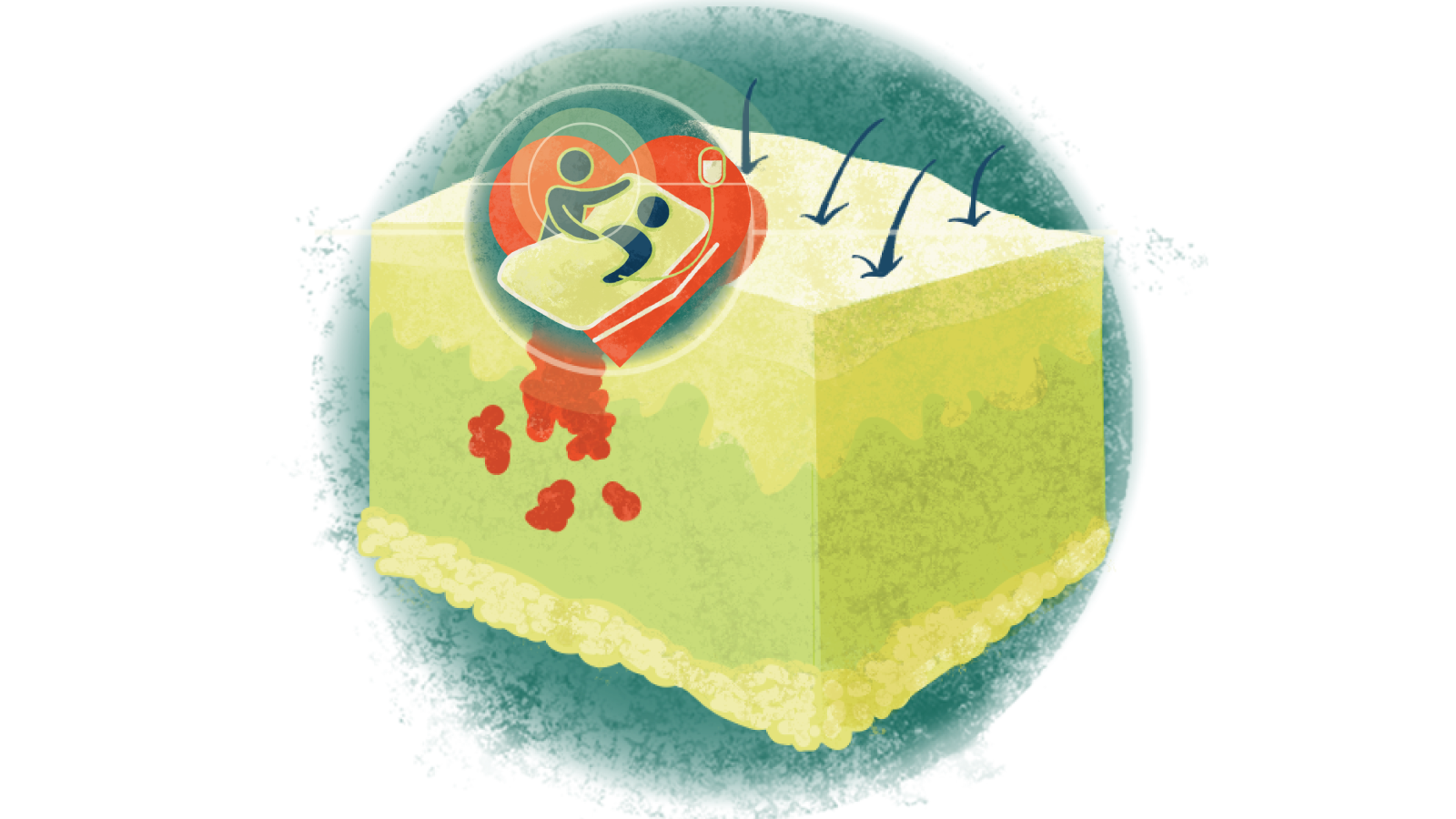 Illustration of a caregiver taking care of a patient with an IV in bed in a circle over melanoma of the skin