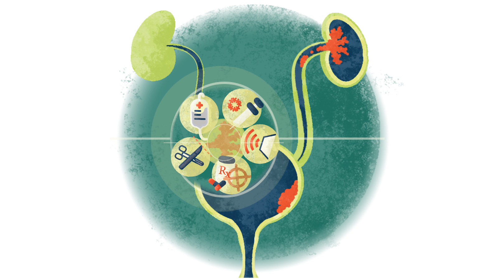 Illustration of 5 circles with different treatment options over over a bladder with urothelial cancer