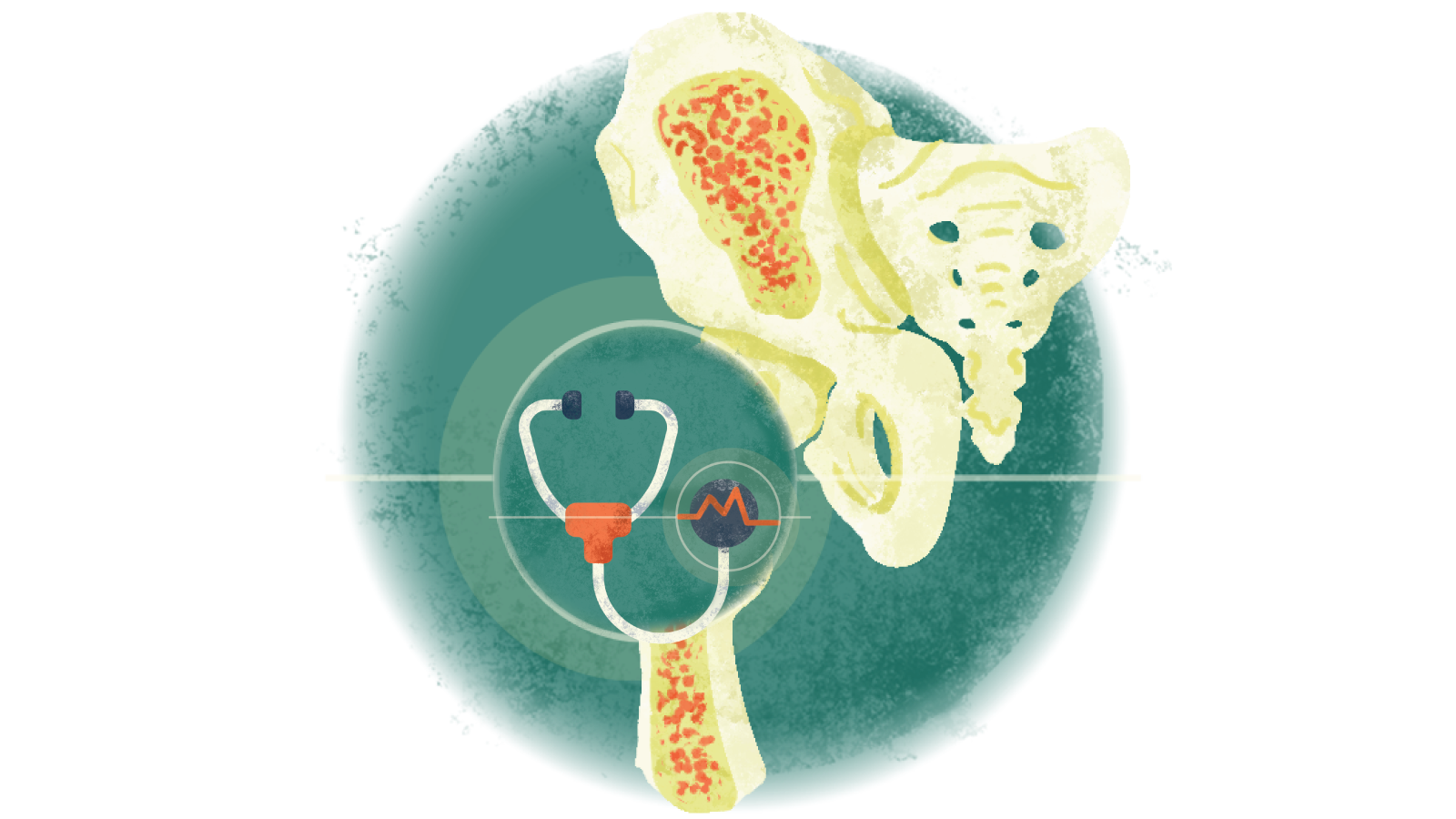 Illustration of a stethoscope with an electrocardiogram in a circle over osteoporosis