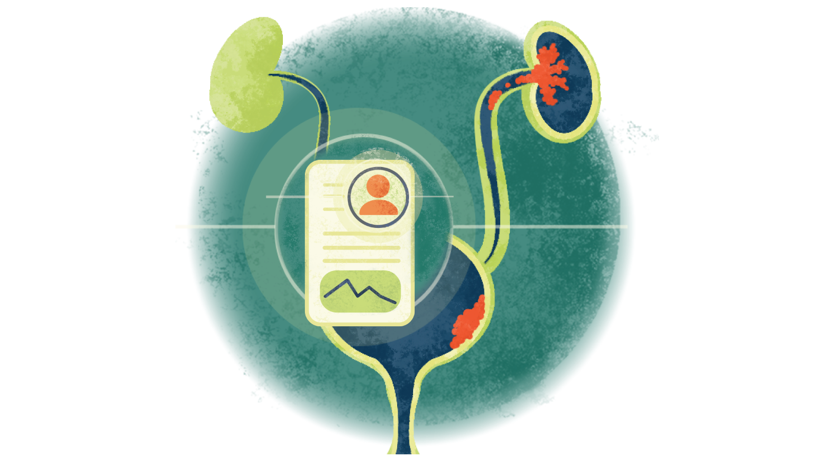 Illustration of a written case study over a bladder with urothelial cancer