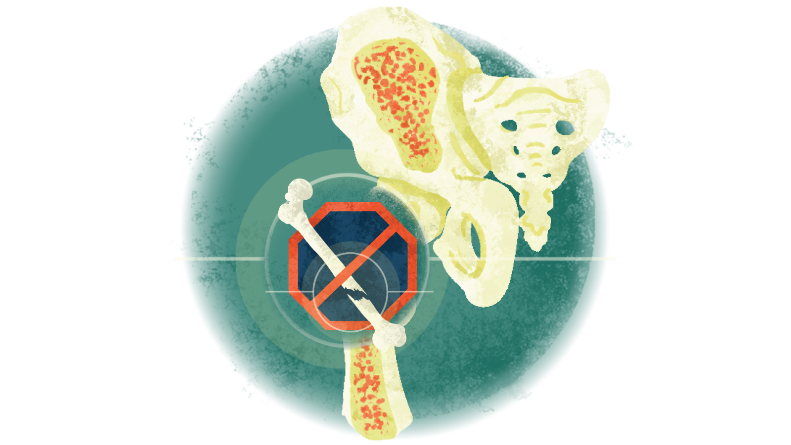 Illustration of a broken bone inside a red hexagon with a red slash over the bone over osteoporosis