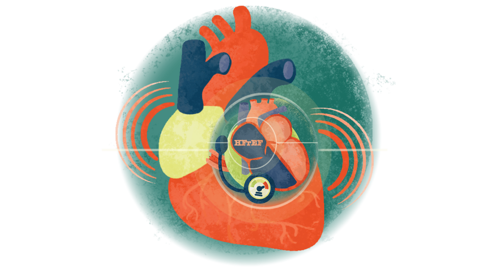 Illustration of a stethoscope over the letters HFrEF over a heart in failure