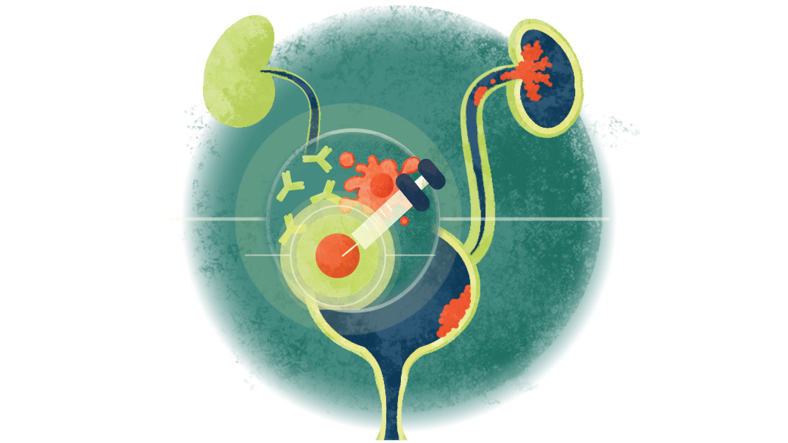 Illustration of a syringe injecting medicine over a bladder with urothelial cancer