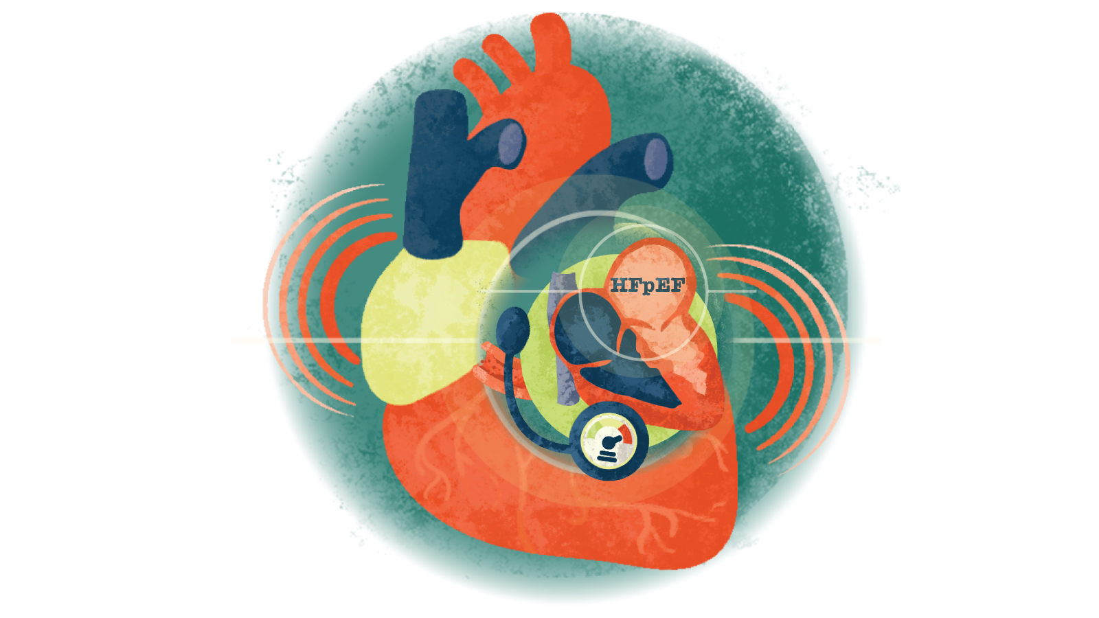 Illustration of a stethoscope over the letters HFrEF over a heart in failure