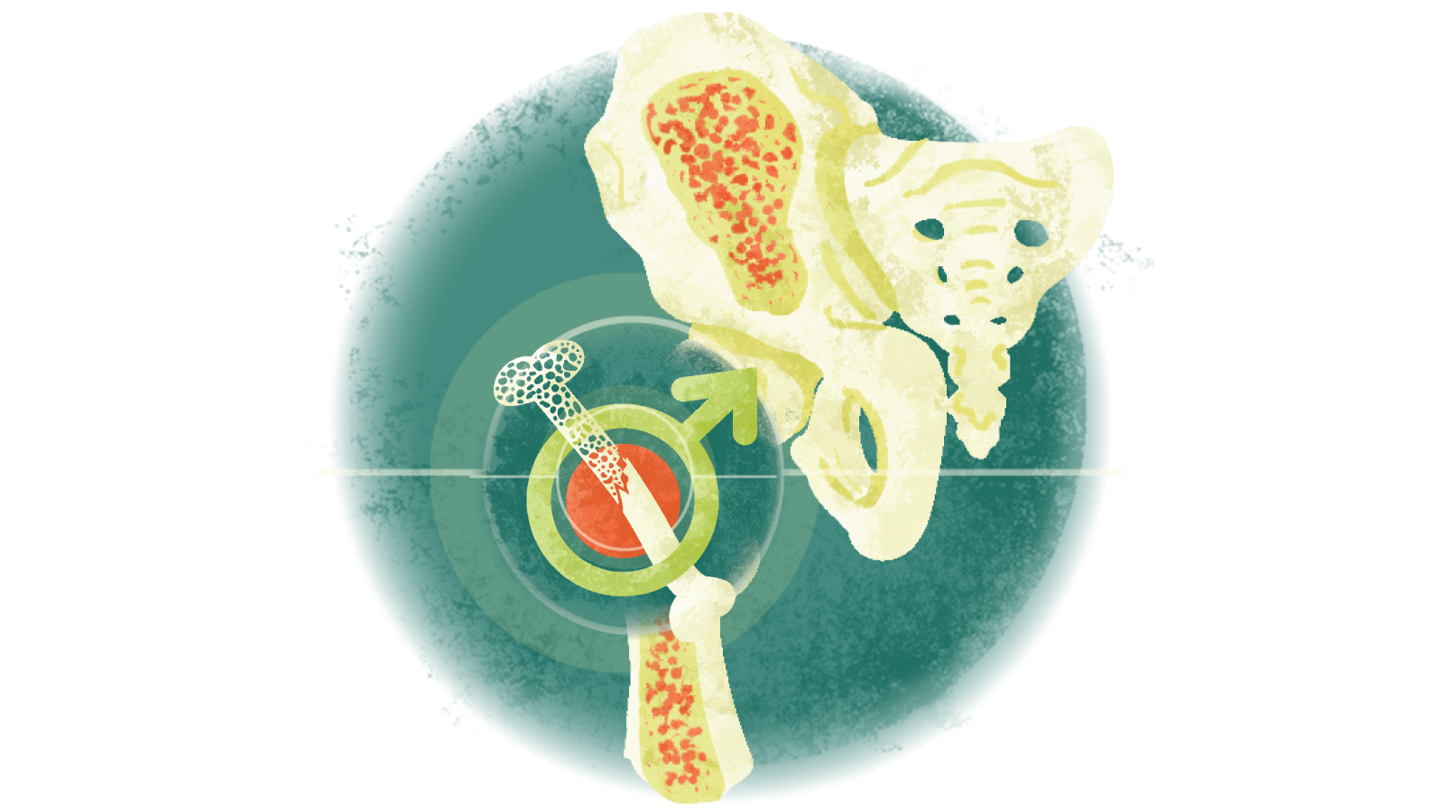 Illustration of a broken bone inside a male gender icon over a bone with osteoporosis
