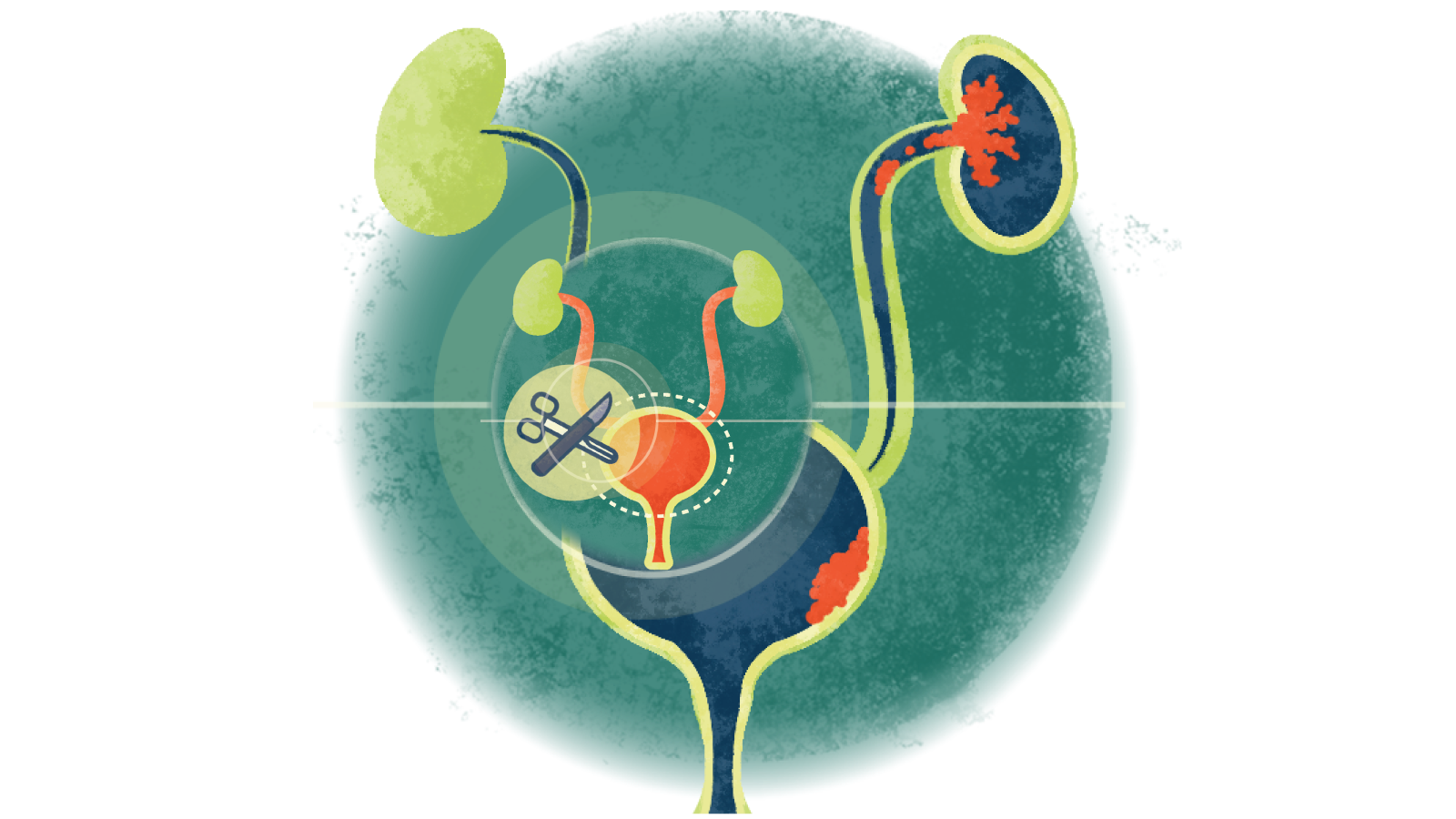 Illustration of a scalpel and scissors over a bladder with urothelial cancer