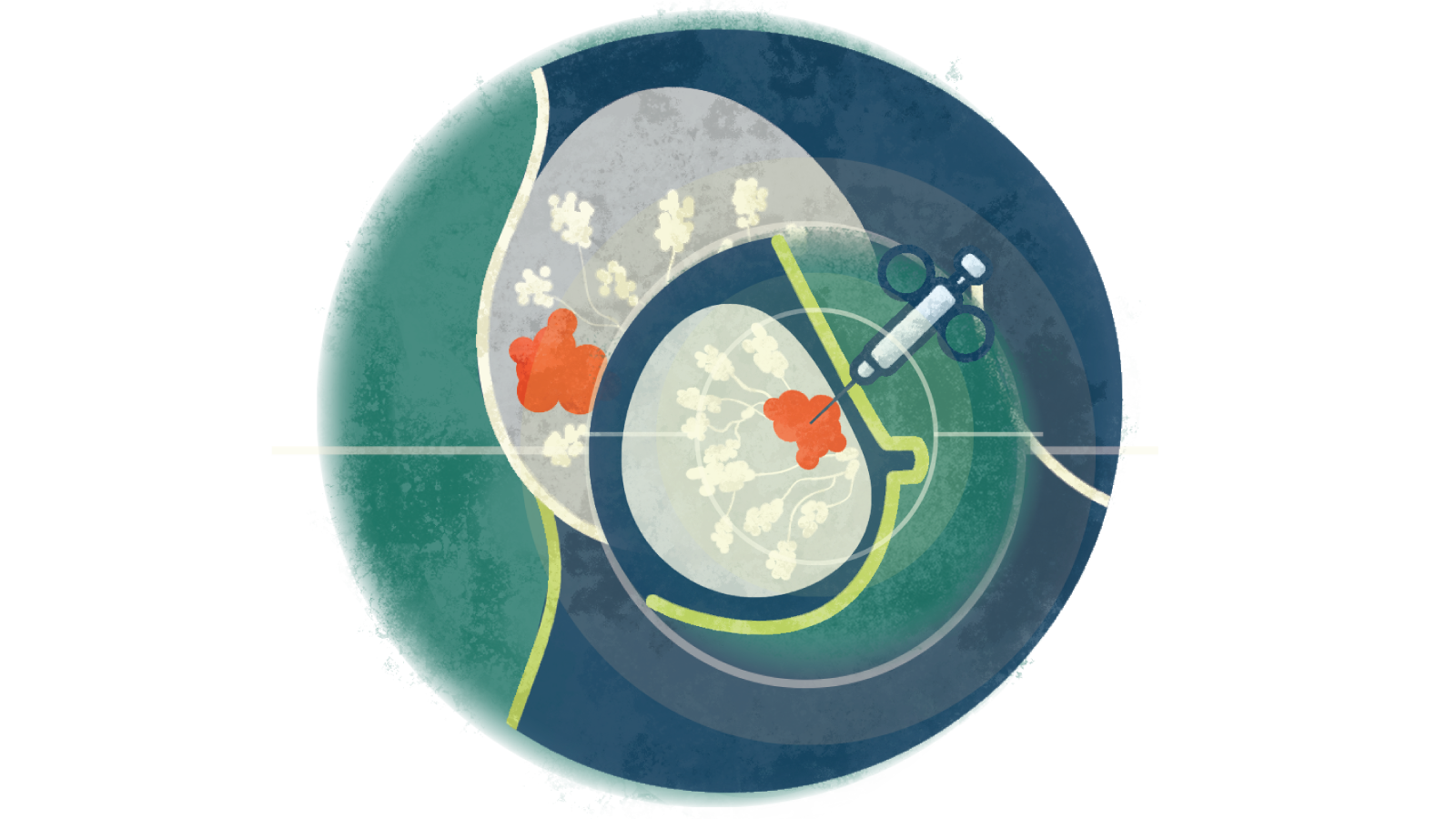 Illustration of an biopsy being taken from a breast with cancer