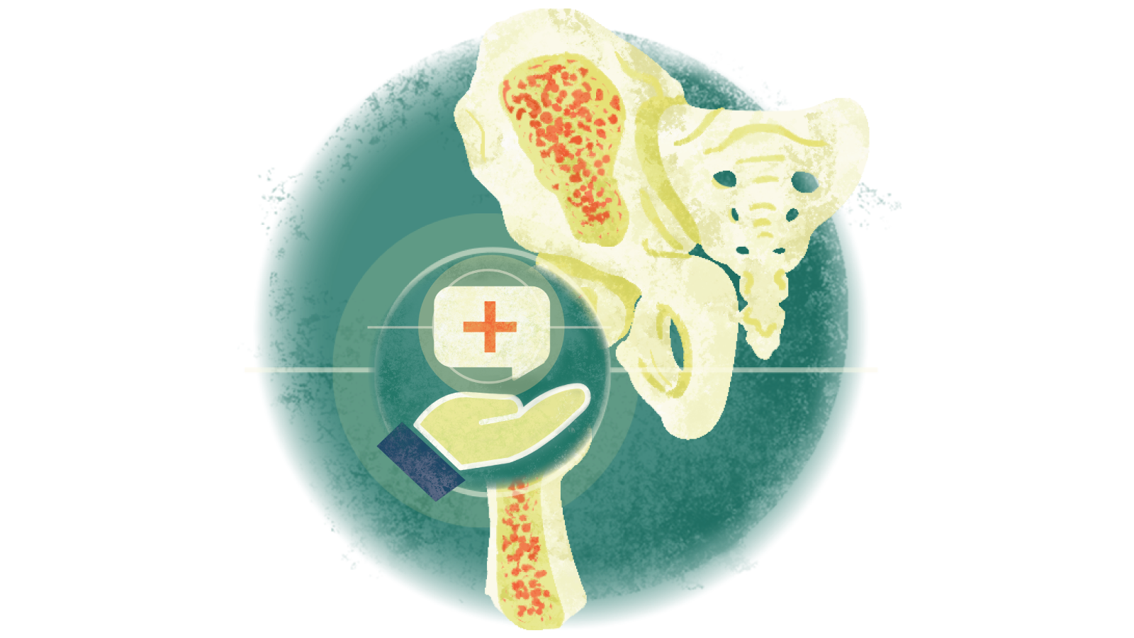 Illustration of a hand holding a red plus sign in a speech bubble over a bone with osteoporosis