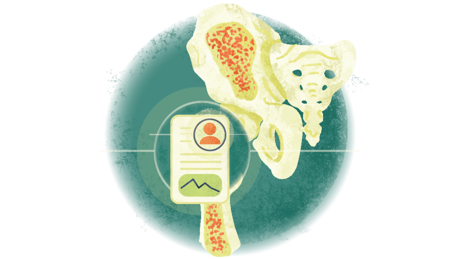 Illustration of a written case study over a circle over osteoporosis
