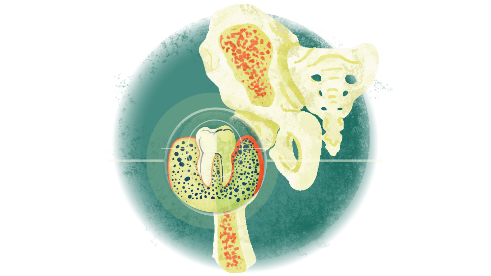 Illustration of a tooth over a bone with osteoporosis
