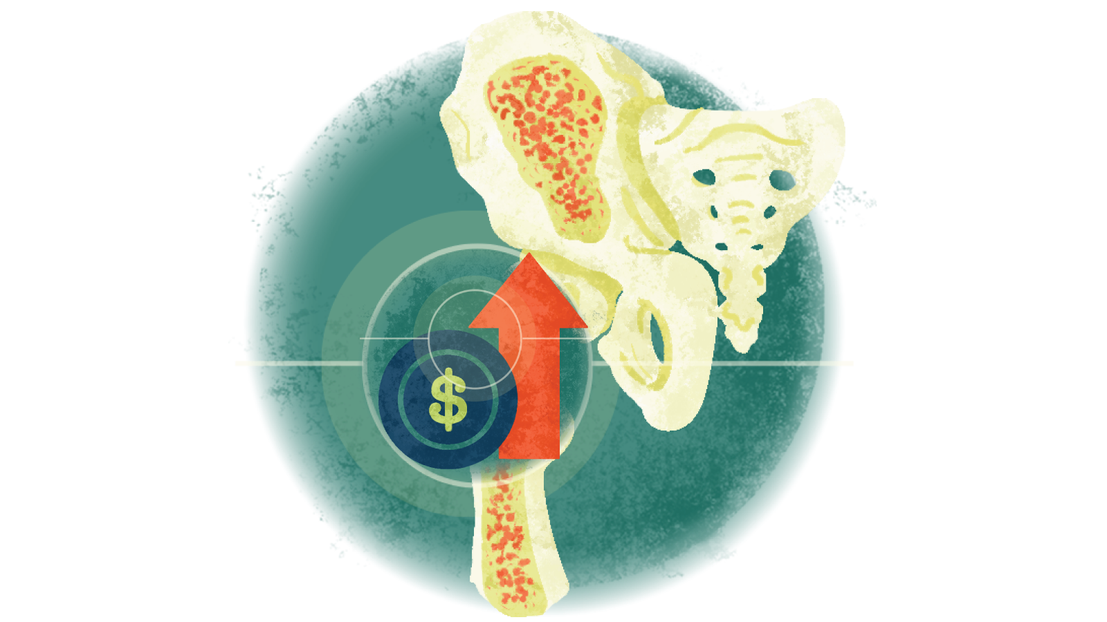 Illustration of a dollar sign and red arrow pointing upwards over a bone with osteoporosis