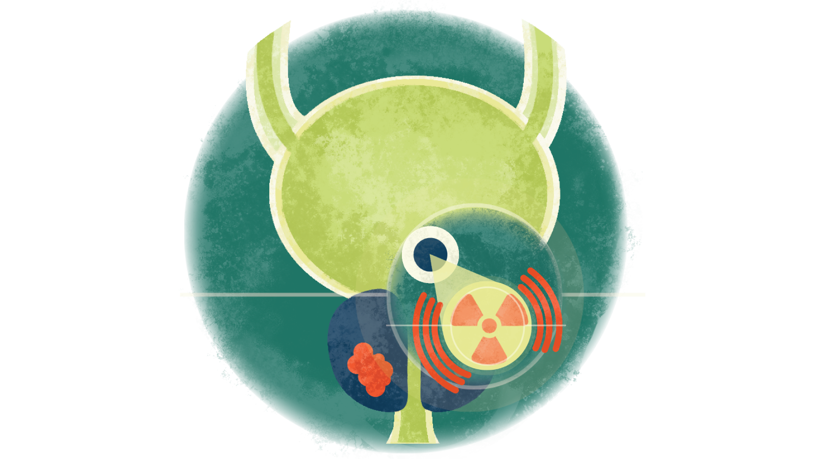 Illustration of radiation therapy over a prostate with cancer