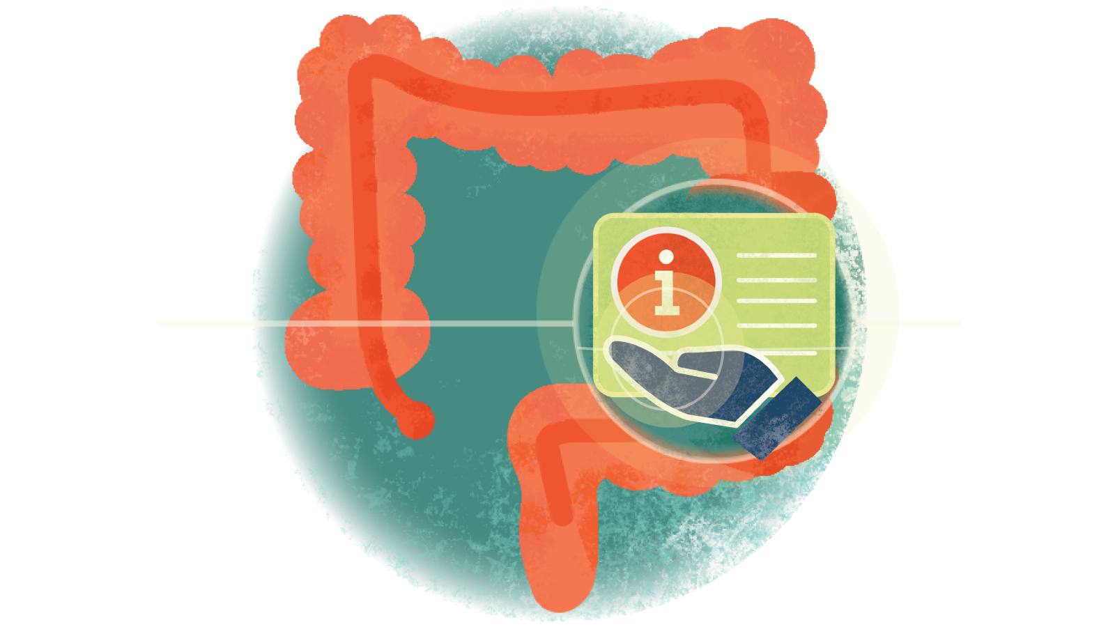 Illustration of the letter i over a hand over a colon with ulcerative colitis 