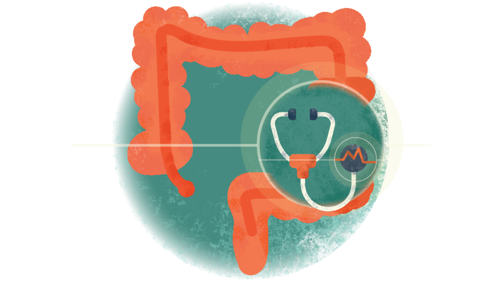 Illustration of a stethoscope with an electrocardiogram over a colon with ulcerative colitis 