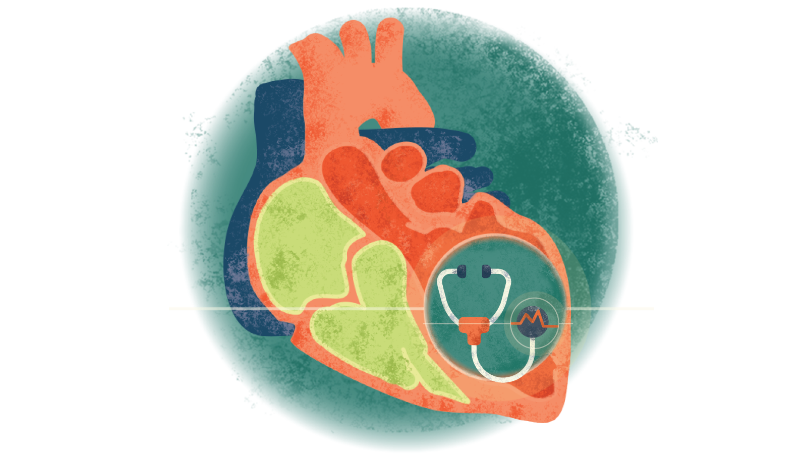 Illustration of a stethoscope with an electrocardiogram over a heart with cardiomyopathy
