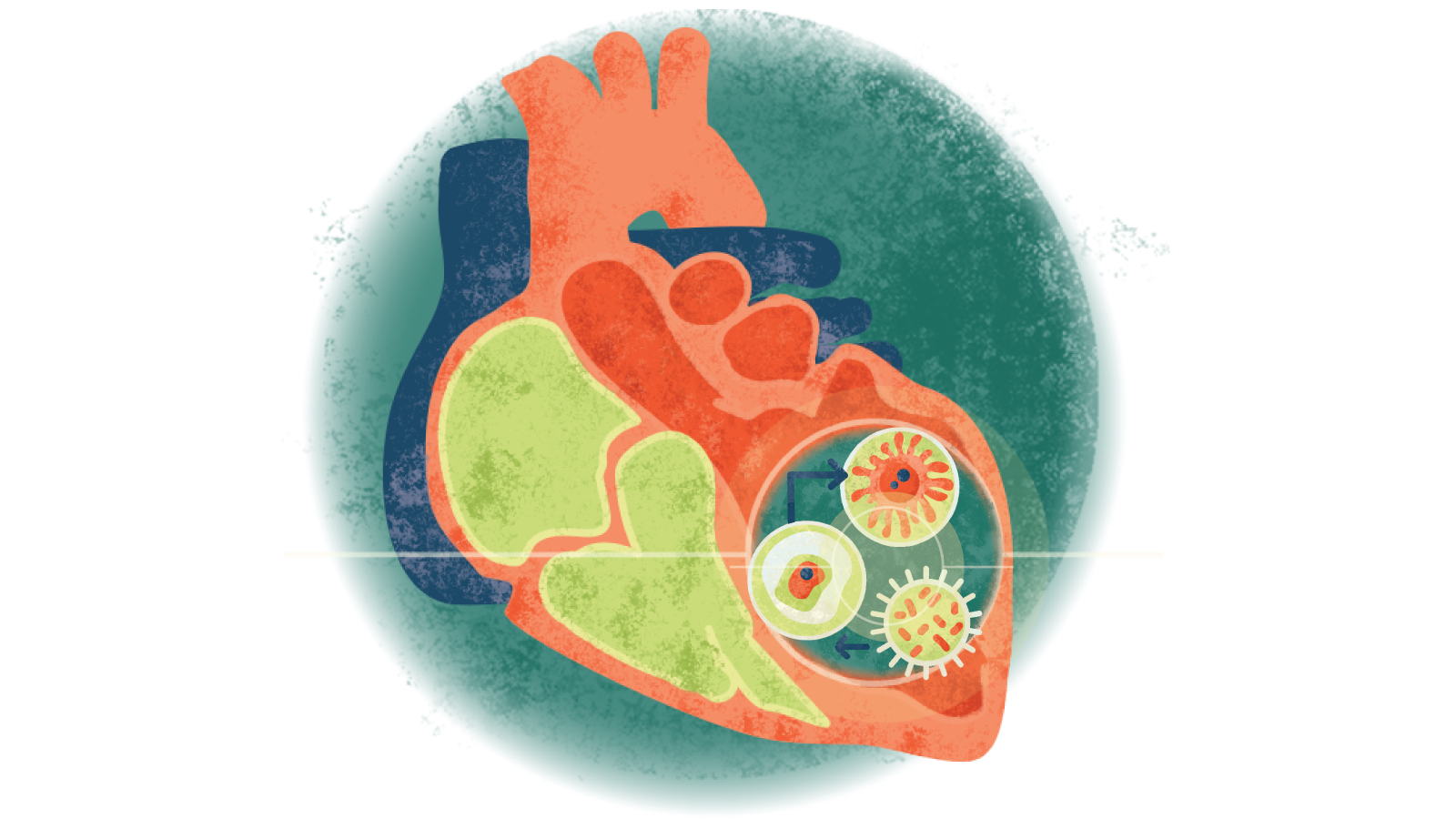 Illustration of different forms of cardiomyopathy over a heart