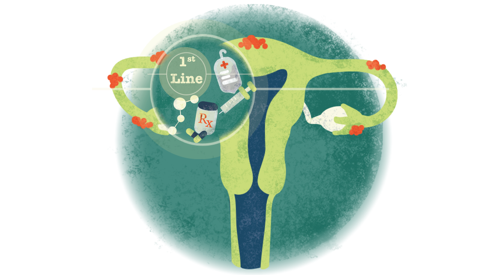 Illustration of pills, syringe, IV bag with text 1st in a circle over a uterus with endometriosis