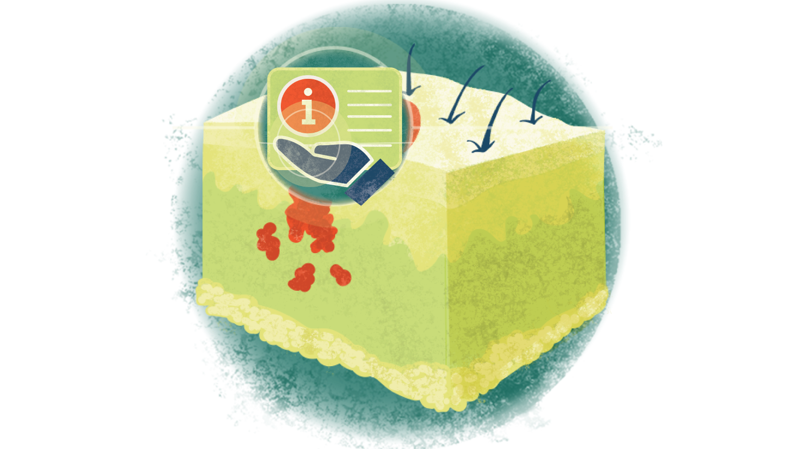 Illustration of the letter i over a hand over melanoma of the skin
