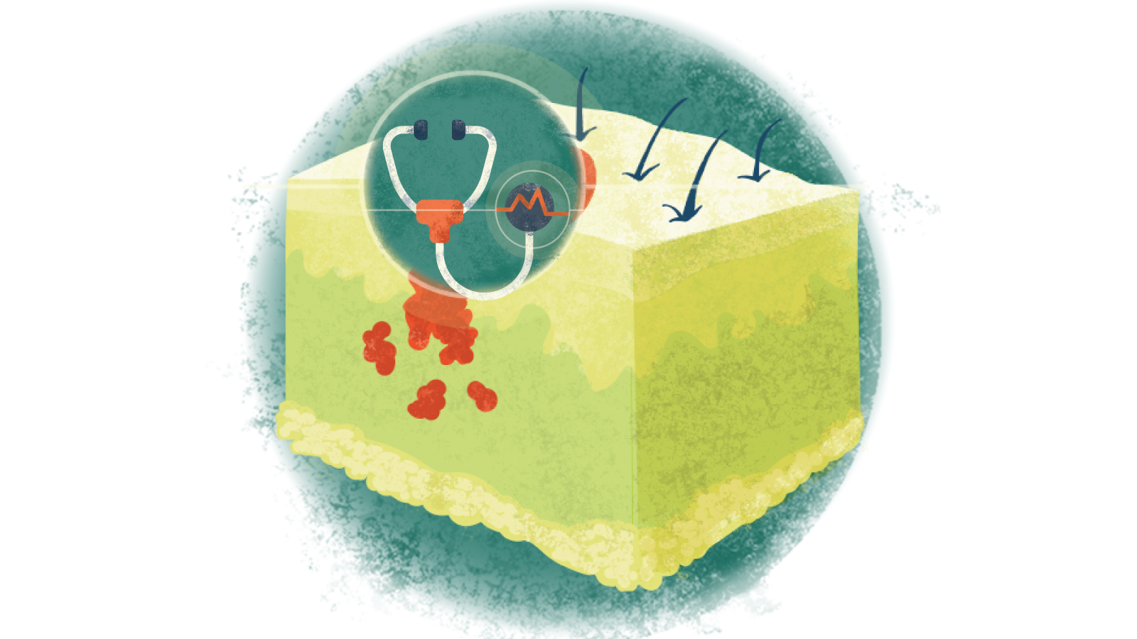 Illustration of a stethoscope with an electrocardiogram over melanoma of the skin