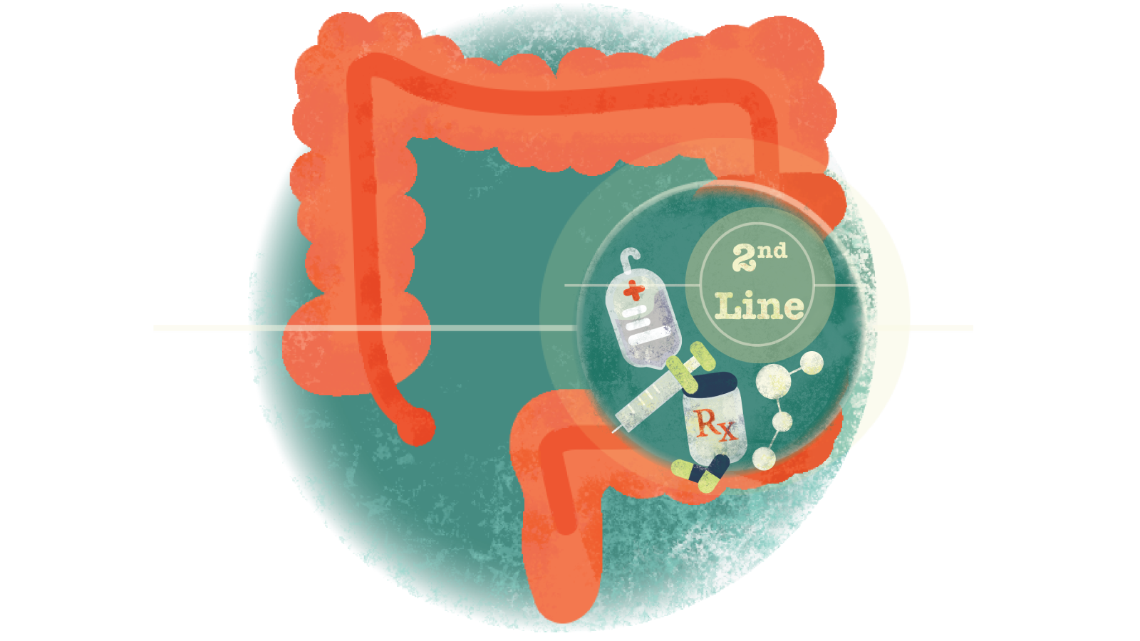 Illustration of pills, syringe, IV bag with text 2nd Line in a circle over a colon with ulcerative colitis