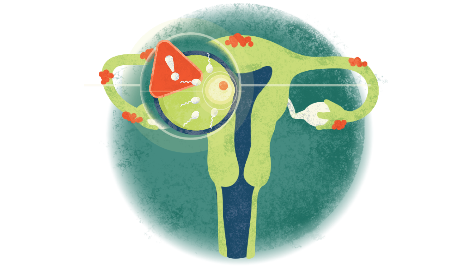 Illustration of sperm swimming towards egg and an explanation point in a triangle over a uterus with endometriosis