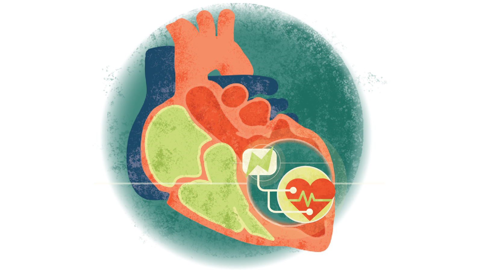 Illustration of an electrical jolt with an electrocardiogram over a heart in a circle over a heart with cardiomyopathy
